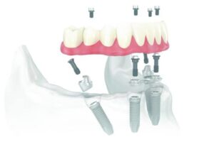 All on 4 Dental Implants in South Lake Tahoe - East Peak Dental