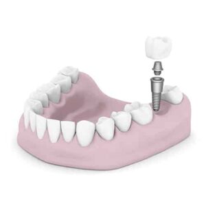 Dental Implant - South Lake Tahoe - East Peak Dental