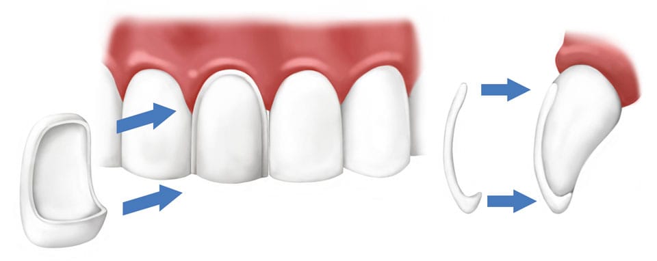 Dental Porcelain Veneers - Ford Dental Group - Huntington Beach Best Dentist