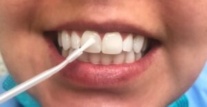 Fluoride Treatment in Stateline, NV - East Peak Dental