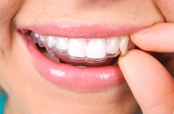 Featured image for “Invisalign”