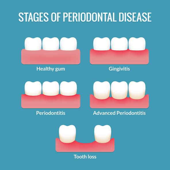 Periodontal Health and the Stages of Periodontal Disease - Ford Dental Group - Huntington Beach, CA