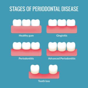 Periodontal Disease Stages - East Peak Dental - Nicole Gordon, DDS and Derek Appelblatt, DDS