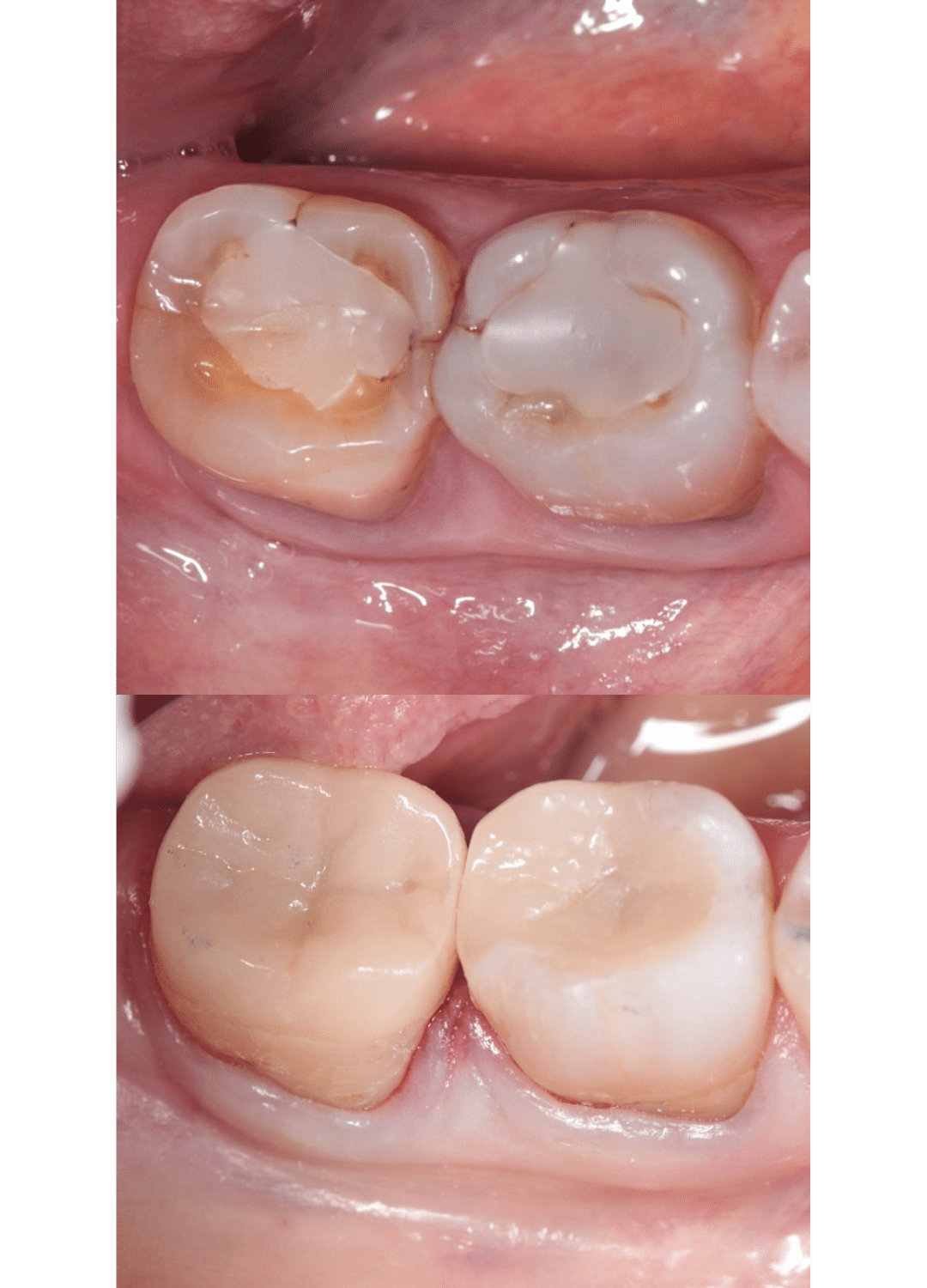 Featured image for “Dental Crown”